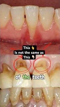 How to Fix Receding Gums and Tooth Neck Wear: Causes & Treatments