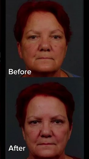 MicroLaser Peel with Sciton Laser: The Secret to Smooth, Radiant Skin