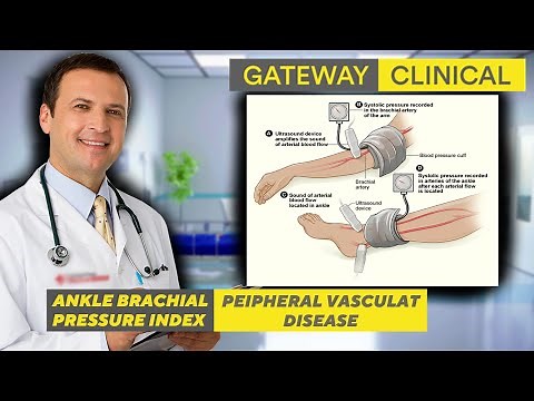 Understanding Ankle Brachial Pressure Index (ABI) in Peripheral Vascular Disease | Gateway Clinical