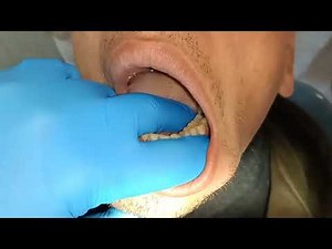 Closed Extraction lower Molar Wisdom.