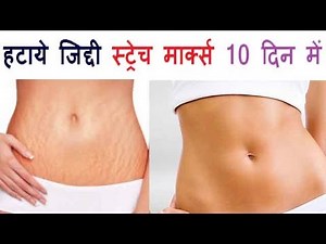 Remove Stretch Marks In Ten Days With These 4 Natural Remedies 100% Working and Effective