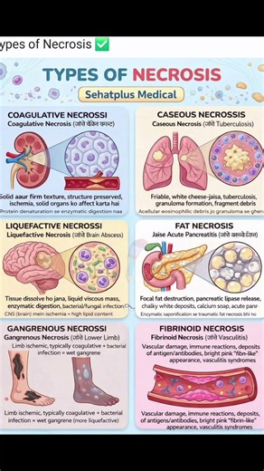 Types of Necrosis Explained in Hinglish | Coagulative, Caseous, Liquefactive | Sehatplus Medical