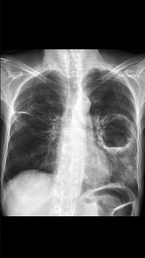Pulmonary Abscess on Chest X-ray #shorts