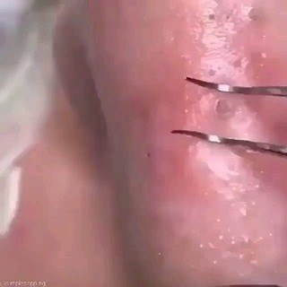 Big Pimple Videos | Follow us ?? @cyst.removal.videos for more pimple popping videos?? #pores #acne #skincare #blackheads #pimples #whiteheads #pimple... | Instagram