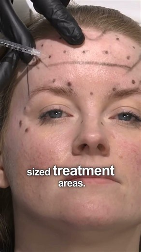 How much does Botox spread? WATCH THIS