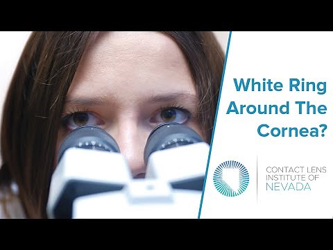 Corneal Arcus (White Ring Around Cornea) And What You Need To Know