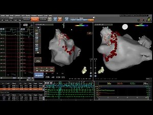 Pulmonary Veins Isolation using Carto® 3