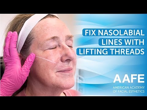Fix Nasolabial Lines with Lifting Threads