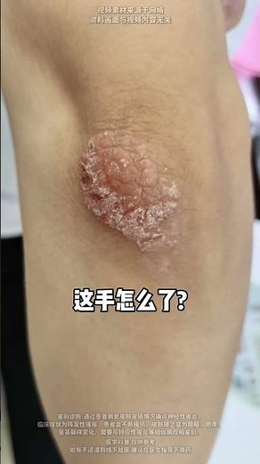 手上常见的几种皮肤问题，是什么？怎么处理？ #手部护理 #角化型湿疹 #手干燥粗糙 #科普 #雷诺现象