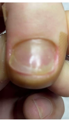Specialty Care Clinic for Onychogryphosis, Thickened Nails, and Nail Deformities