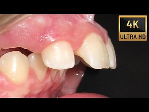 OVERJET - buck teeth timelapse #4k #dentist #orthodontics