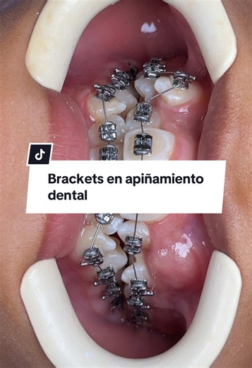 Brackets en apiñamiento dental: colocación ortodoncia