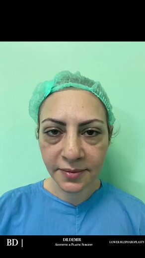 Let’s see the lower blepharoplasty operation result after a month. İf you interested in blepharoplasty in istanbul, please send us DM . . . . . #blepharoplasty #cirurgiaplastica #plasticsurgery #switzerland # #blepharoplastie #blepharoplastik #blefaroplastica #blefaroplasticaroma #blefaroplastia #estético