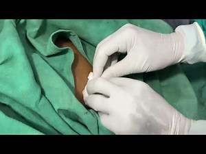 How to remove pigtail catheter #doctor #healthgyan #pleasesubscribe