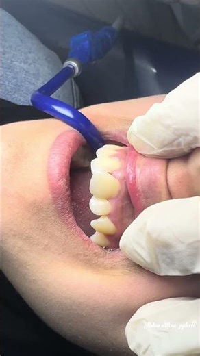 The dangers of crowded teeth... the hidden cause of front tooth decay #Dr_Abdullah_Sultan #dentist