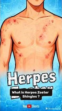 What is Herpes Zoster?#whatmed