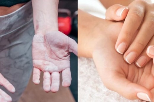 4 passos caseiros para eliminar calos nas mãos e deixar a pele lisinha