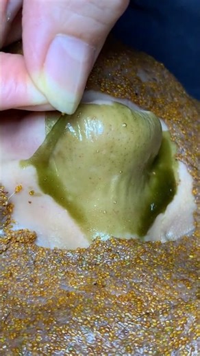 Instant 😲 Remove Whitehead + Blackhead Deep Cleaning | Skincare Treatment 😱