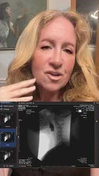 Barium Swallow Study which shows a progression in my esophageal dysmotility