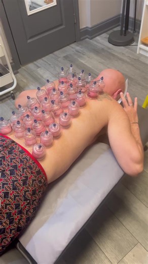 🏆 Cupping therapy uses suction to lift and decompress layers of fascia and muscle, helping improve blood flow, reduce stiffness, and ease deep muscle tension. Great for recovery and stress relief—sometimes you need to pull to release. #CuppingTherapy #MyofascialRelease #ChicagoChiropractic #ChiropracticCare #drkyleross