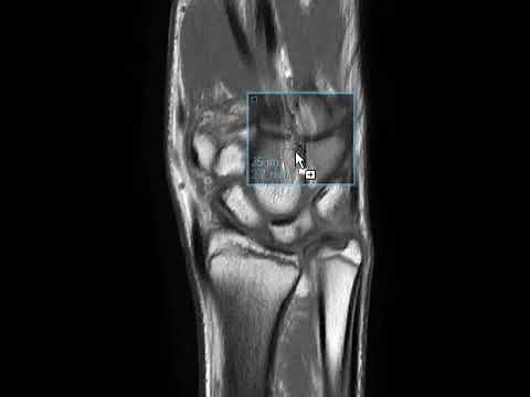 Volar intercalated segment instability (VISI)