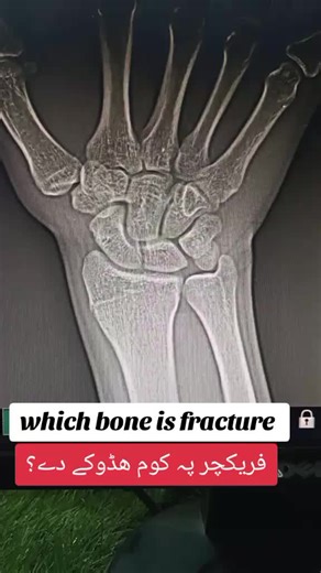 Understanding Wrist Fractures: Types and Treatments