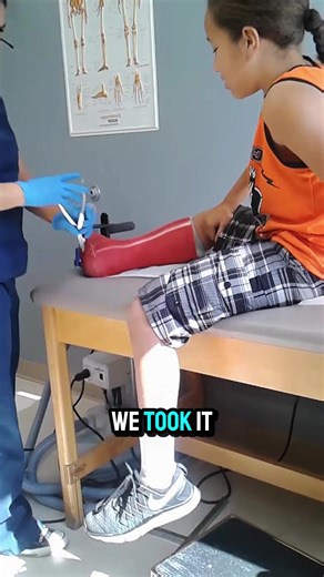 Nurse Help Patient Removal Cast Leg Broken 😱 #castremoval #help #brokenleg #removal #patient