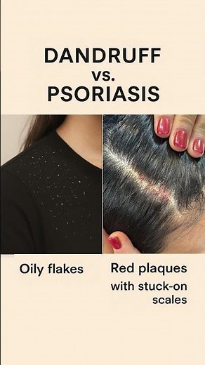 Scalp Psoriasis vs Dandruff: Key Differences You Need to Know