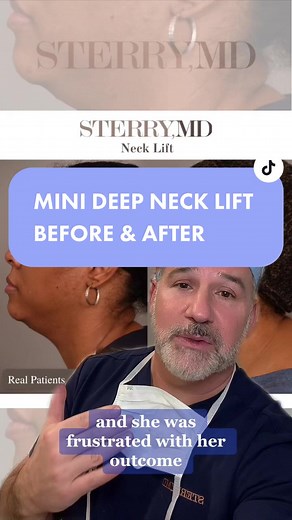 Mini deep neck lift before & after on our patient! #greenscreen #mininecklift #necklift #plasticsurgeonsoftiktok #beforeandafter