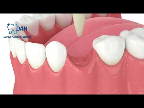 extraction / removal of a tooth