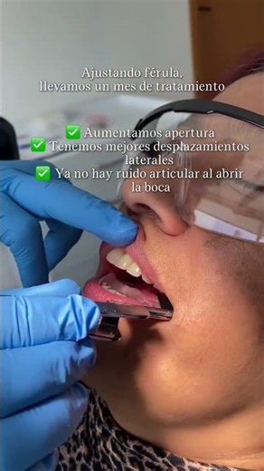 Férula Gnatológica para tratamiento articular