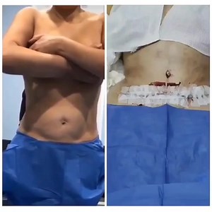 3.4K views | Resultados que pensarás que no son posibles, en Corpus and Rostrum los hacemos una realidad. Ven y sorpréndete con los increíbles resultados que puedes lucir con una lipoabdominiplastia y reducción de cintura. ¡Agenda tu cita de valoración ahora!  55 5393 7834 ó 55 5393 8901 #Abdominoplastia #Plicatura #CirugíaPlástica | Corpus & Rostrum | Facebook