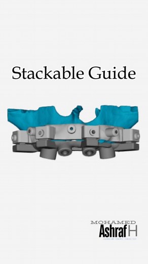 DentaTech Hub | Digital Dentistry on Instagram: "🦷🎯 CAD Workflow Spotlight – Stackable Surgical Guide for All-on-4 in @atomica.ai 💻 What you’ll see: a step‑by‑step walkthrough of stacking the guide components for precise dental implant placement. 🧩 Why stackable Guides ? • Layered guides enhance implant positioning accuracy through modular stacking . • Improves workflow efficiency and precision, especially in full‑arch and bone-reduction cases . • Digital advantages: streamlined CAD/CAM work