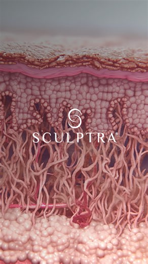 Aesthetics by Galderma on Instagram: "How does Sculptra® work deep within your skin to create changes inside and out? This video gives you a look at how the unique PLLA-SCA™ activates collagen and elastin production within 14 days of injection. By month three, it increases Type I collagen production in your skin by 66.5% and improves the quality of elastin by 34%. Upon injection, Sculptra® diffuses PLLA-SCA™ in the dermis, remodeling across all three layers of the skin for a truly regenerative e