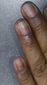 My Nails Coming Off | Onycholysis -#shorts