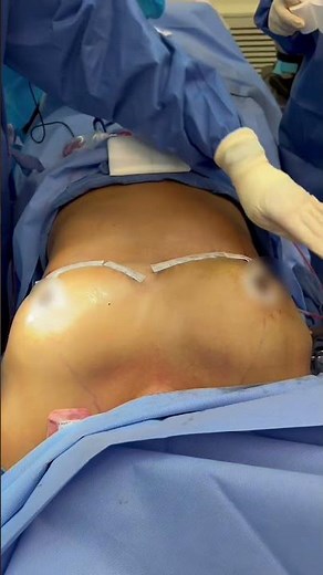 Watch this amazing Breast Reduction + Lift Transformation !