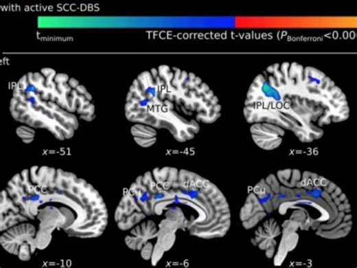 FMRI原理与任务态fMRI(SPM)