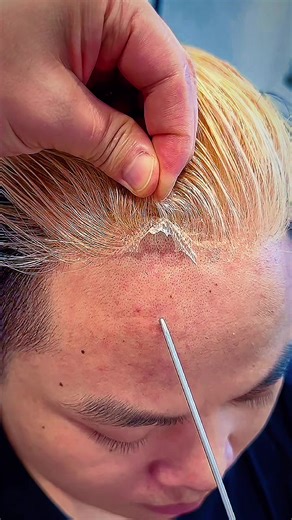 Discover the Best Hair Replacement Solutions for Men