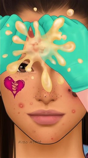 ASMR Oddly Satisfying Pimple Popping | Acne & Blackheads Extraction #animation #asmr #2danimation