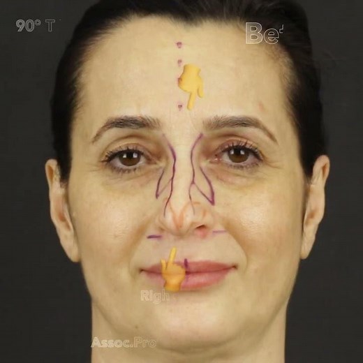 Nose Job Before and After Video