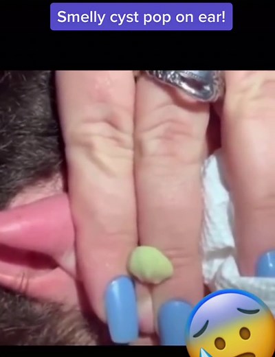 Smelly cyst pop behind ear! #cystpopping #cystexplosion #oddlysatisfying #blackheadextraction #whiteheadpimples #dilatedpore #cysts #pimplepoppingheaven