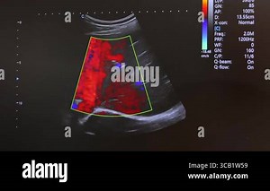 Ultrasound transesophageal examination of the heart.