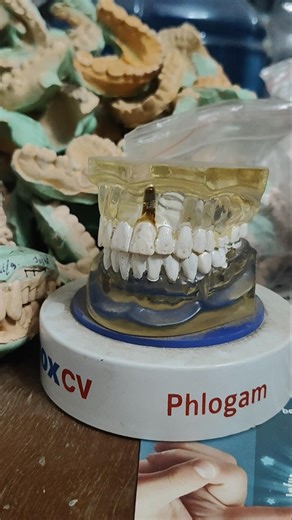 Dentures/False teeth #falseteeth #denture #teethwhitening #tooth #medicalstudent