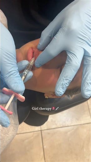 Dental block for lip filler always🫶🏼