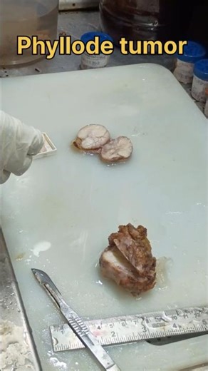 Phyllode tumor video| #histopathology #breastcancerawareness #phyllodes #tumor #breastcancer #lump