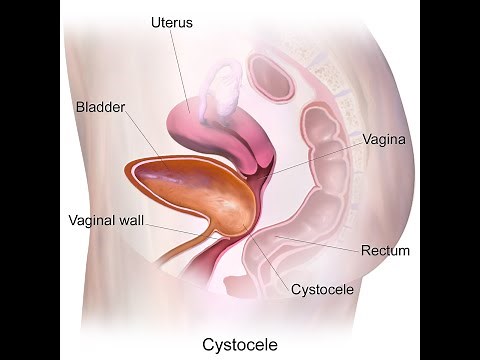 Anterior & Posterior Colporrhaphy | Cystocele | Rectocele | Mesh | Uterovaginal Prolapse - Dr Rams