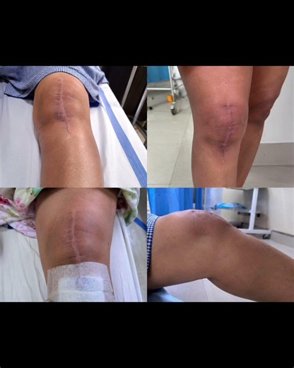 ✅Total knee replacement🦵 #physiotherapy #kneereplacement surgery#shorts #viralshorts#Dr.pujithaPT.