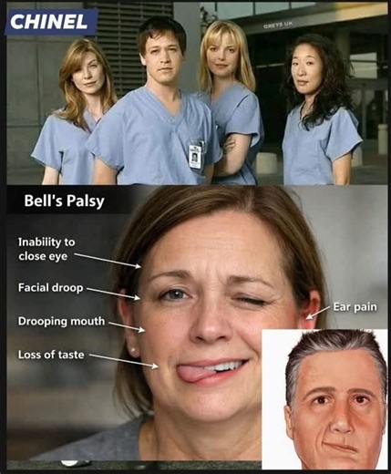 Nurse Chinel on Instagram: "Bell’s Palsy Bell’s palsy is a disorder characterized by sudden weakness or paralysis of the facial muscles on one side of the face. It occurs when the facial nerve (cranial nerve VII) becomes inflamed or compressed. Key Features - Sudden onset, typically developing over hours to 1–2 days - One-sided facial drooping - Difficulty with facial movements like smiling, closing the eye, or raising the eyebrow - Drooling or food escaping from the mouth - Partial loss of tast