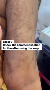 53K views · 544 reactions | I have the best solution for your stretch marks soap in Liberia .. Price is now 30$ for one cup Call..+231886404864 #skincaregoals #GlowInTheDark #stretch | Rozay Organic Skincare | Facebook