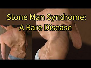 Unveiling FOP: The Stone Man Syndrome